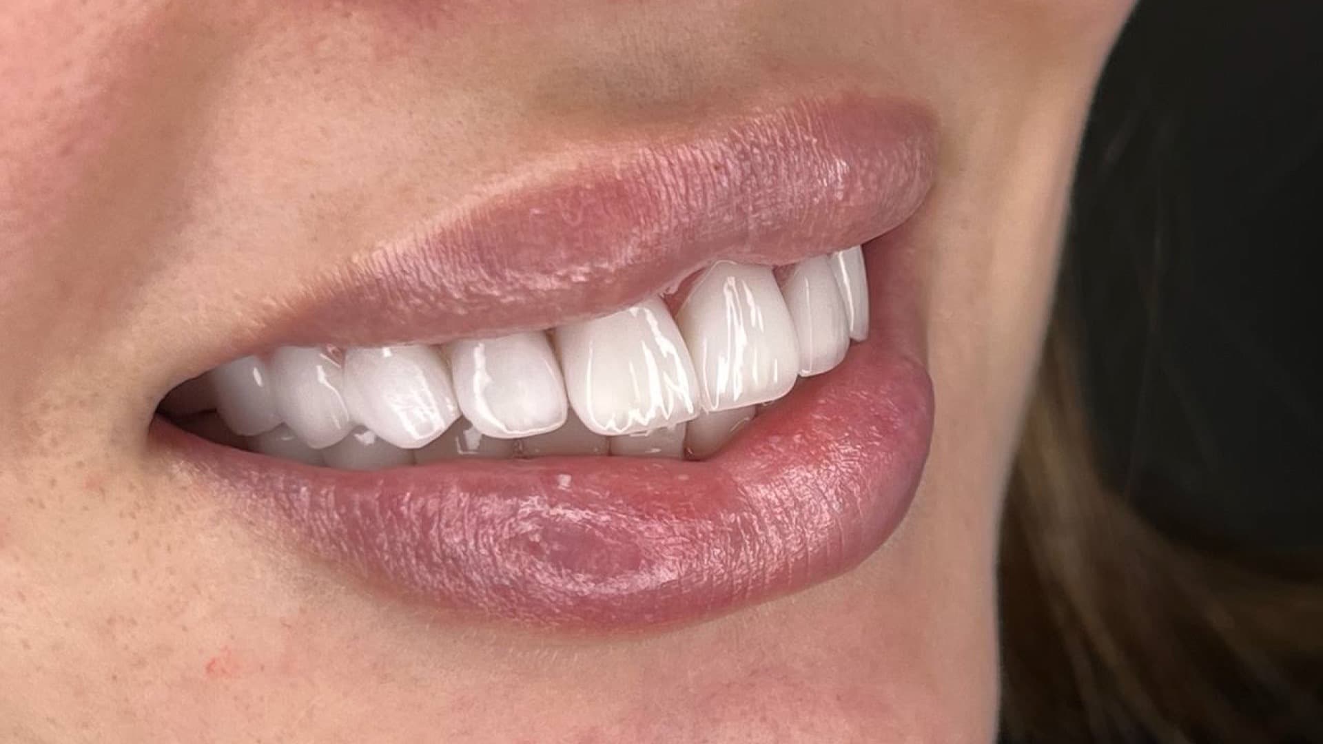 ابتسامة هوليود